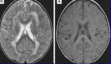 Картинки по запросу мрт лейкодистрофия