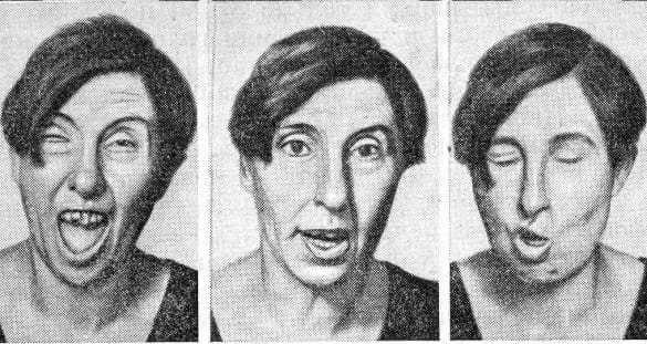 Хорея Гентингтона