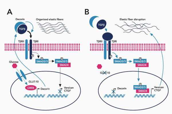 Нарушение эластических фибрилл соединительной ткани
