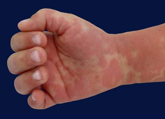 Болезнь Кавасаки