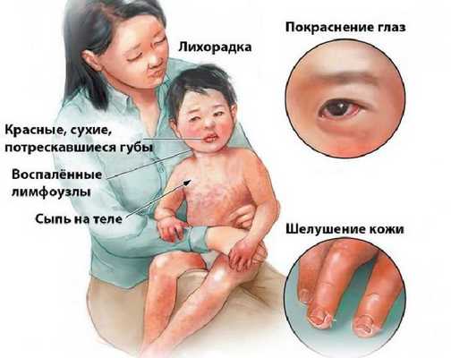 Проявления болезни Кавасаки