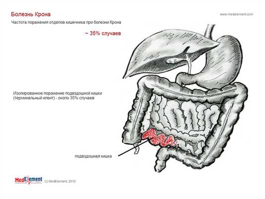 Болезнь Крона (терминальный илеит)