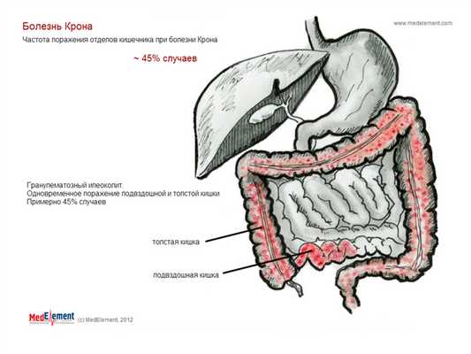 Болезнь Крона (гранулематозный илеоколит)