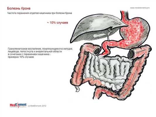Болезнь Крона - воспаление в желудке, пищеводе, полости рта и аноректальной области в сочетании с поражением кишечника