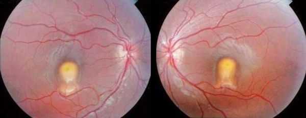 Вторая стадия болезни Беста: асимметричные поражения по типу 