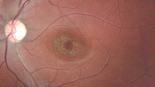 Скопления тёмного пигмента при болезни Штаргардта