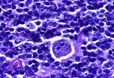 Лимфома Ходжкина