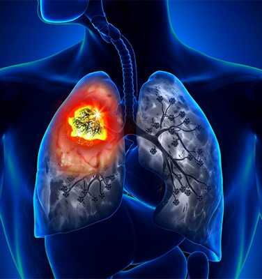 Хронические неспецифические заболевания легких