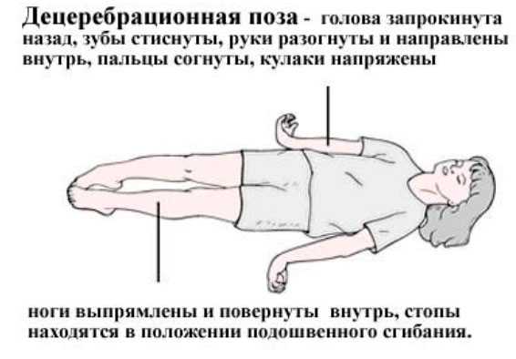 Лейкодистрофия