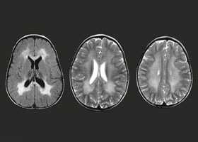 Лейкодистрофия