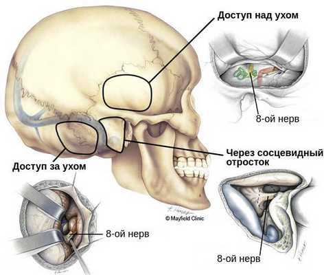 Варианты доступа к невриноме