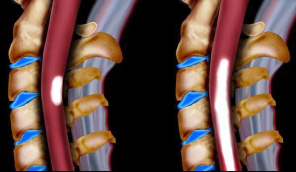 Миелопатия