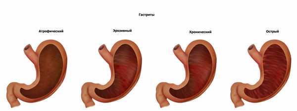 виды гастритов м.jpg