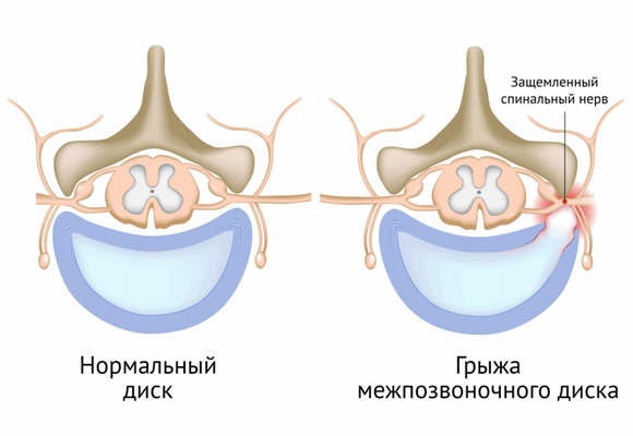Поражения корешков спинного мозга.png