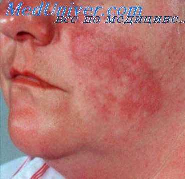 туберкулез кожи