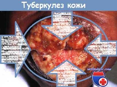 Туберкулез кожи