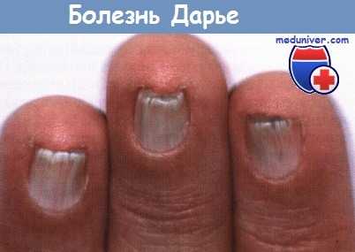 Ногти при болезни Дарье