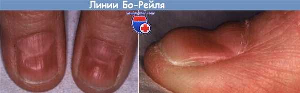 Линии Бо-Рейля