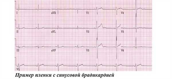 Пример пленки с синусовой брадикардией