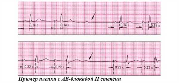 Пример пленки с АВ-блокадой II степени