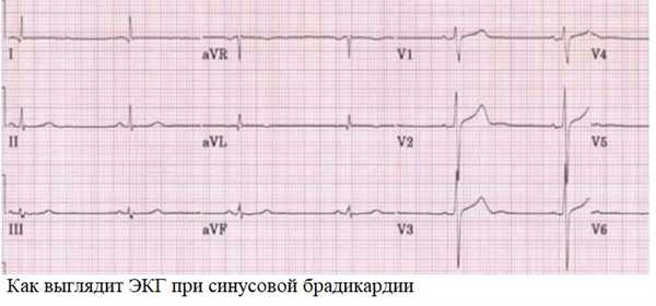 Как выглядит ЭКГ при синусовой брадикардии