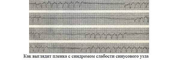 Пленка с синдромом слабости синусового узла
