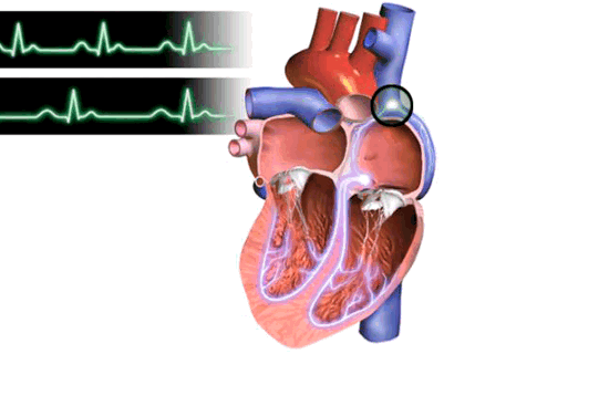 Лечение брадикардии. Когда сердцу нужна помощь?