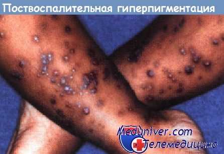 Поствоспалительная гиперпигментация у ребенка