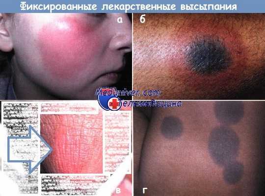 Фиксированные лекарственные высыпания