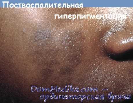 Поствоспалительная гиперпигментация