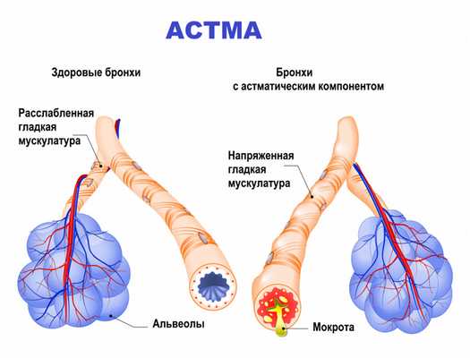 Астма.jpg