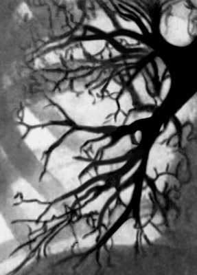 Рис. а). Бронхограмма: в норме (дана для сравнения)