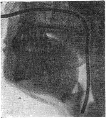 Рис. 1. Положение катетера при трансназальной катетеризации дыхательных путей.