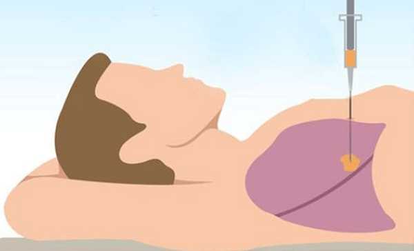 рак-бронхов