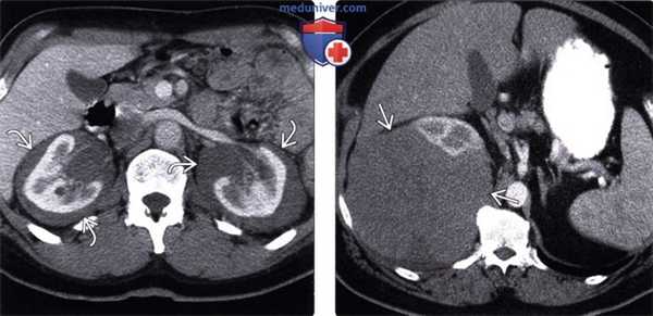 КТ, УЗИ брюшной полости при лейкемии и лимфоме