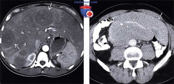 КТ, УЗИ брюшной полости при лейкемии и лимфоме