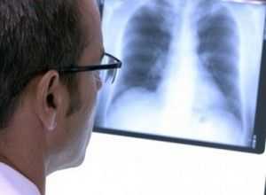 рентгенограмма как метод диагностики эмфиземы