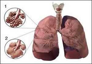 сравнительное изображение нормальных и изменённых альвеом
