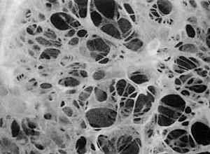 лёгочная ткань поражённая эмфиземой