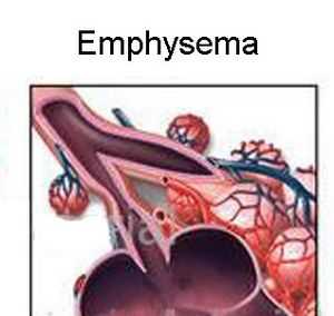 вид изменений в альвеолах