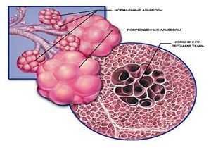 развитие изменений в лёгочной ткани