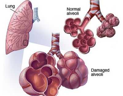 этапы развития эмфиземы