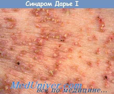 болезнь Дарье