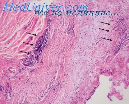 буллезный эпидермолиз