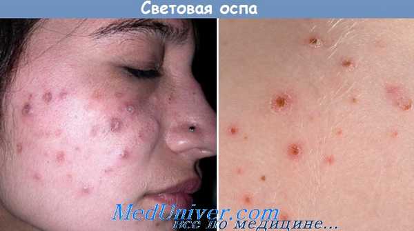 световая оспа