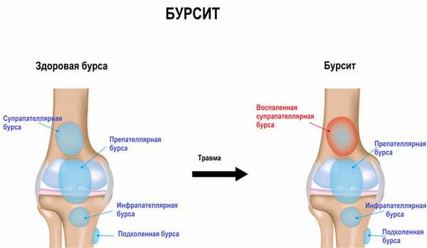Воспаление бурсы.jpg