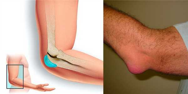 Локтевой бурсит