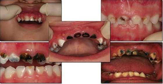 Развитие бутылочного кариеса