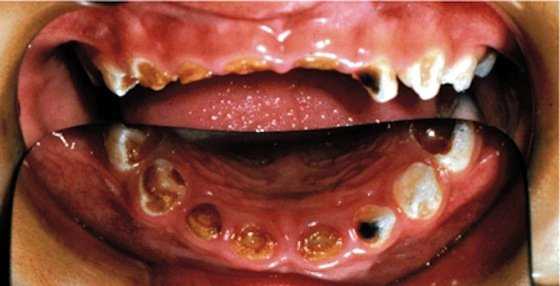 Глубокая стадия бутылочного кариеса