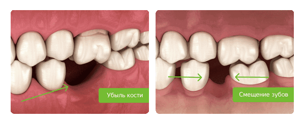 последствия отсутствия зуба